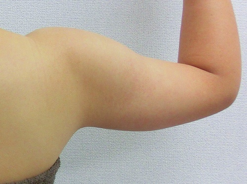 二の腕脂肪吸引前3 二の腕脂肪吸引前3