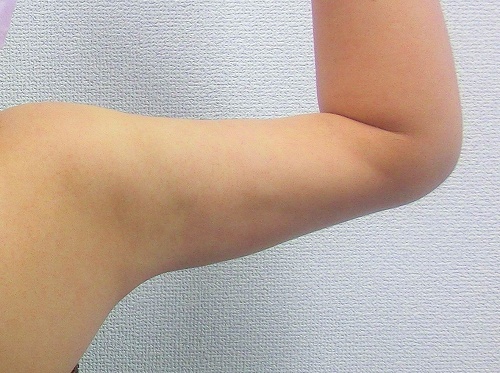二の腕脂肪吸引後4 二の腕脂肪吸引後4
