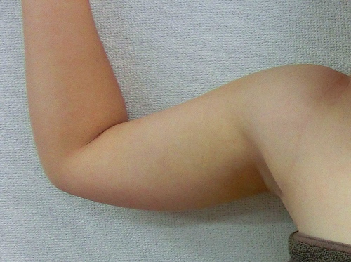 二の腕脂肪吸引前5 二の腕脂肪吸引前5