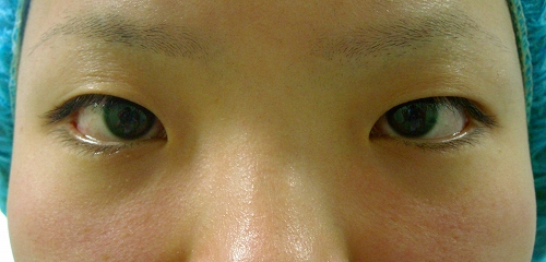 二重埋没法前 二重埋没法前