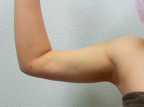 二の腕脂肪吸引後6 二の腕脂肪吸引後6