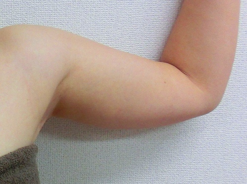 二の腕脂肪吸引前7 二の腕脂肪吸引前7