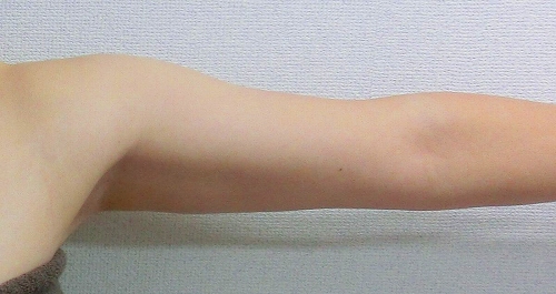二の腕脂肪吸引前9 二の腕脂肪吸引前9