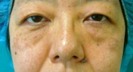 目の下のたるみ取り前 目の下のたるみ取り前