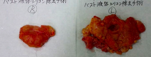 液体シリコン除去 液体シリコン除去