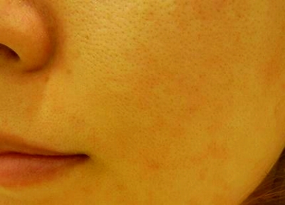 ニキビ治療後 ニキビ治療後