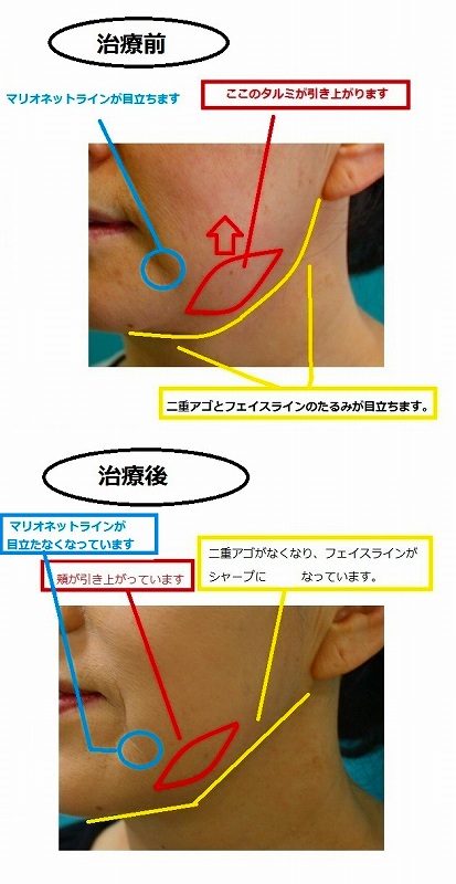 ウルセラ解説 ウルセラ解説