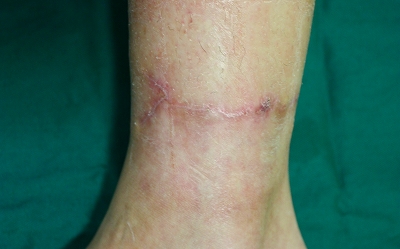 タトゥー切除後約3か月