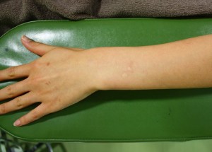 根性焼き、たばこの火傷跡を消す