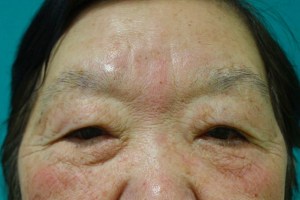 ウルセラのたるみ引き上げ効果はすごい！（２）