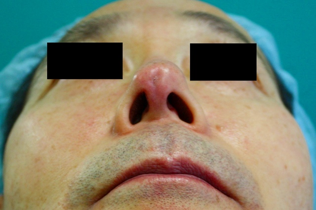 鼻プロテーゼ修正後5M2 鼻プロテーゼ修正後5M2