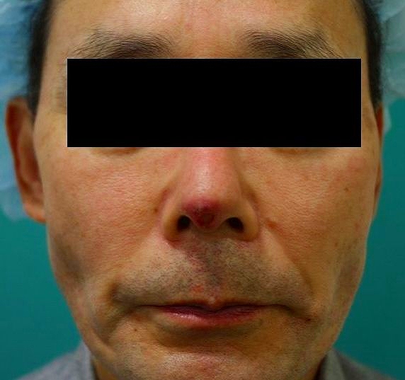鼻プロテーゼ修正前1 鼻プロテーゼ修正前1