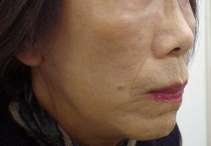 目の下のたるみ取り手術