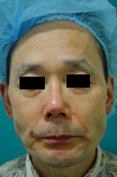 鼻プロテーゼ修正前正面 鼻プロテーゼ修正前正面