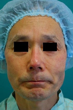鼻プロテーゼ修正後正面 鼻プロテーゼ修正後正面