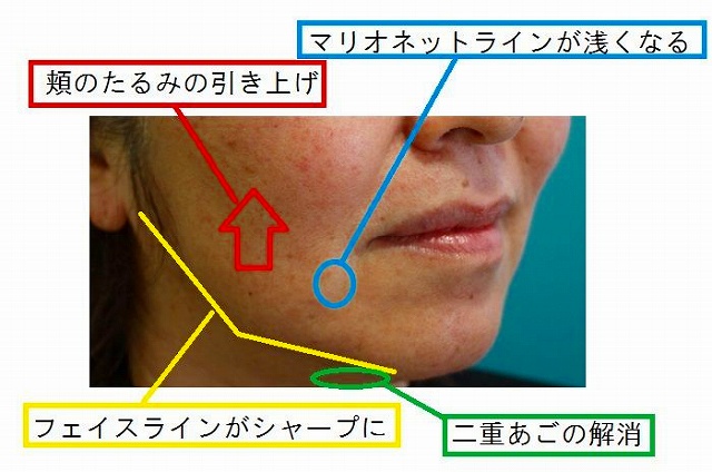 ウルセラ治療後解説 ウルセラ治療後解説