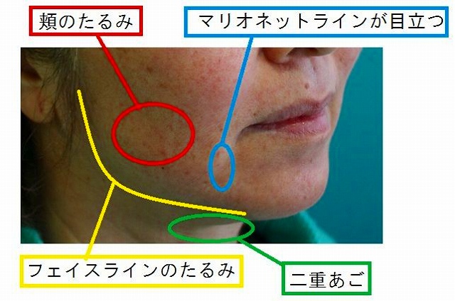 ウルセラ治療前解説 ウルセラ治療前解説