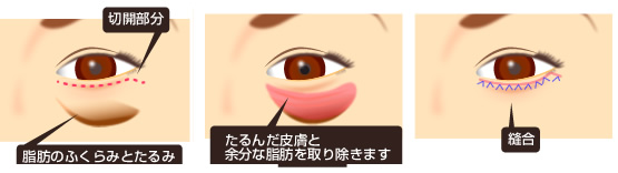 目の下のくま説明1