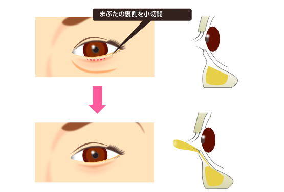 目の下のくま説明2