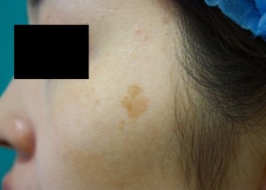 28歳で老人性色素斑