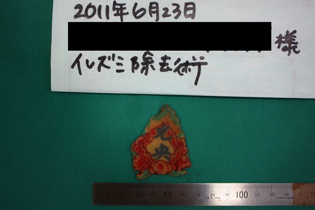 刺青除去皮膚1