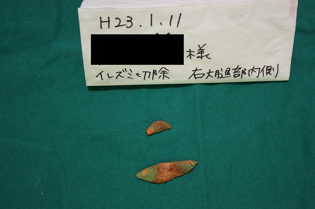 刺青除去皮膚2
