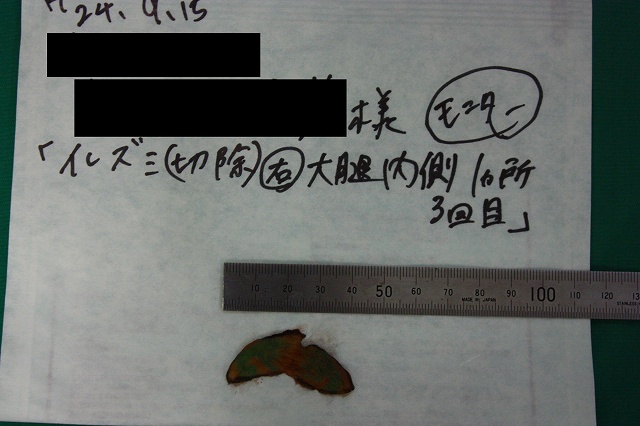 刺青除去皮膚3