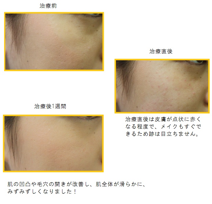 水光注射2