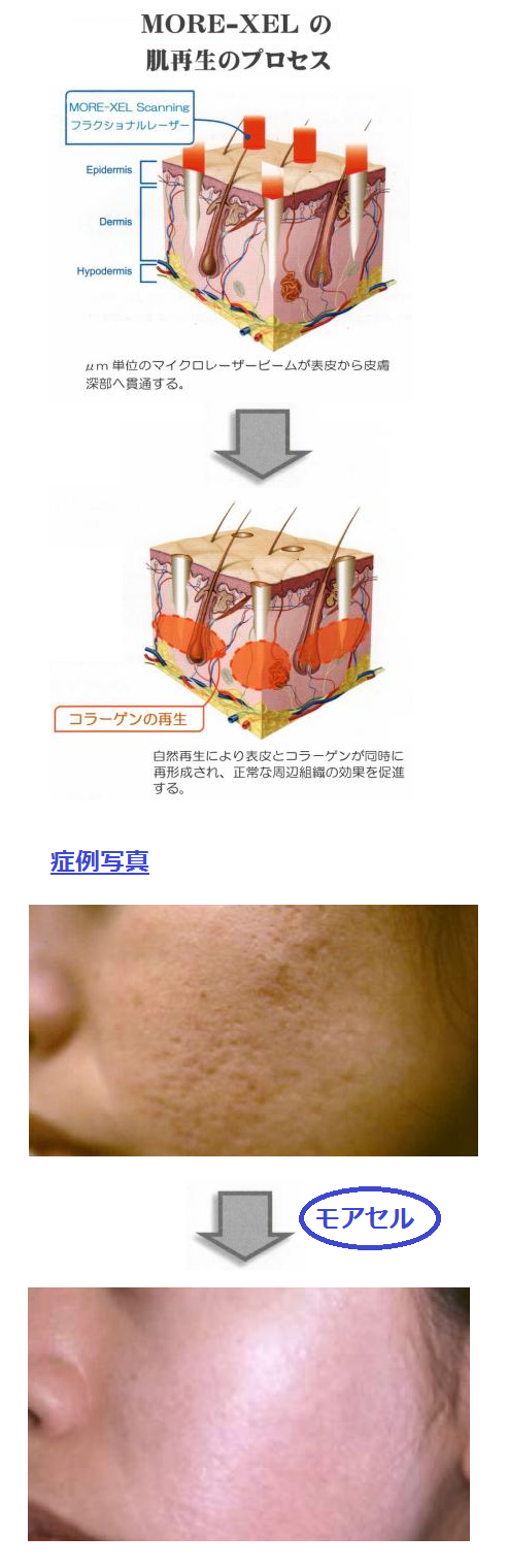 フラクショナルレーザー2