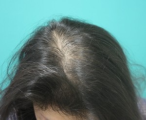 女性ハーグ治療後 女性ハーグ治療後