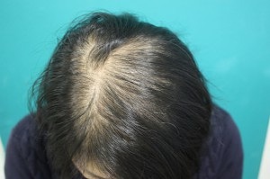 女性ハーグ治療前 女性ハーグ治療前