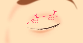 The most popular operation for creating “double eyelid”