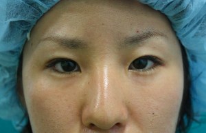 二重まぶた切開法は不自然？