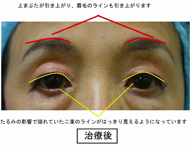 ウルセラ治療後説明 ウルセラ治療後説明