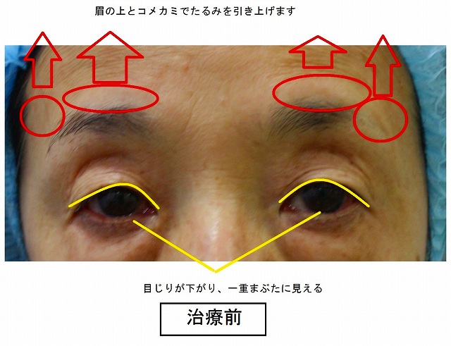 ウルセラ治療前説明 ウルセラ治療前説明
