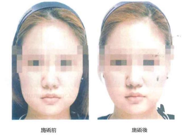 脂肪溶解注射1 脂肪溶解注射1