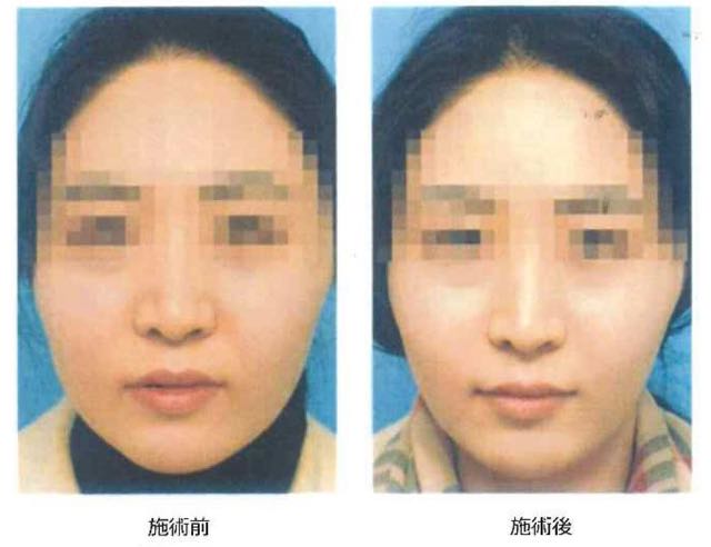 脂肪溶解注射3 脂肪溶解注射3