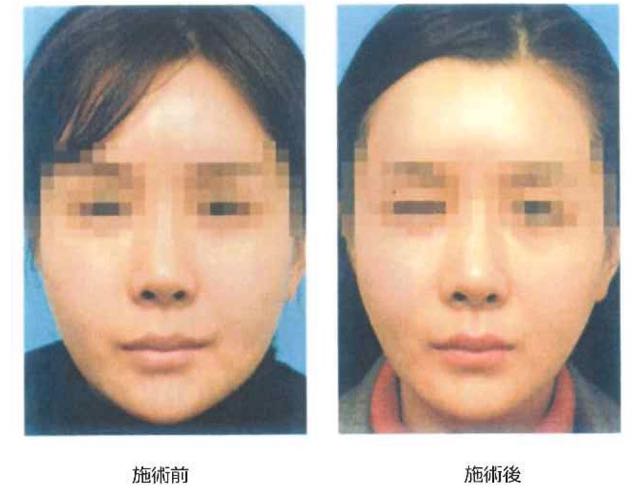 脂肪溶解注射2 脂肪溶解注射2