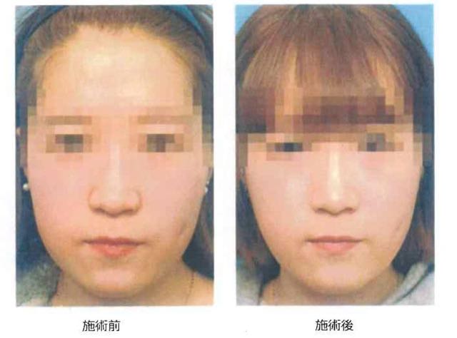 脂肪溶解注射4 脂肪溶解注射4