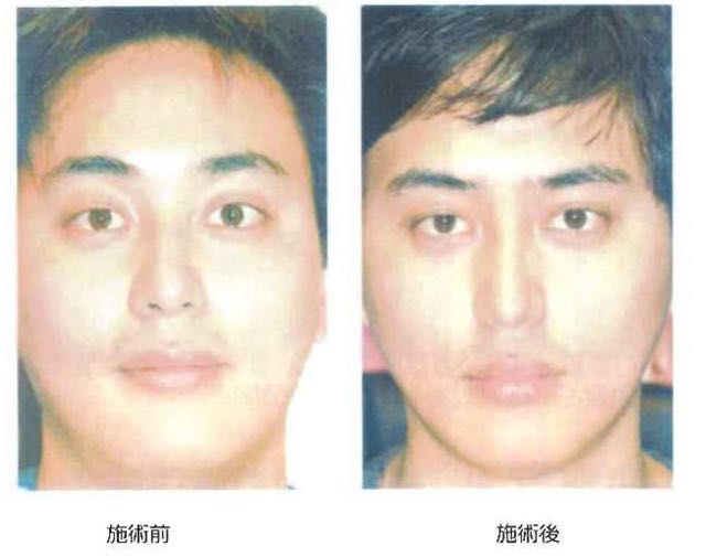 脂肪溶解注射5 脂肪溶解注射5