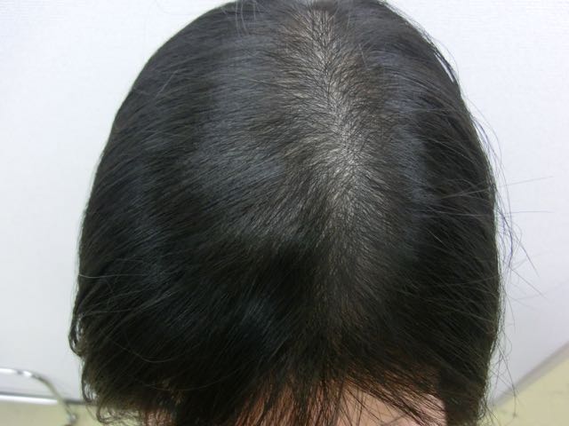 女性薄毛治療後 女性薄毛治療後