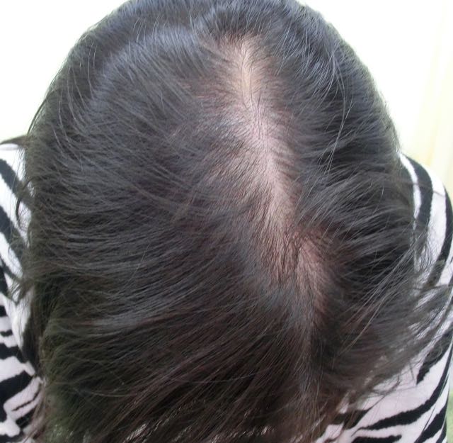 女性薄毛治療前 女性薄毛治療前
