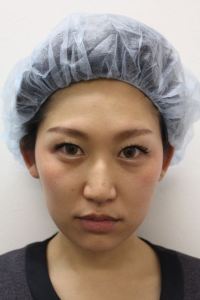 20代でもウルセラ
