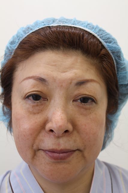 “フェイスリフト前" フェイスリフト前