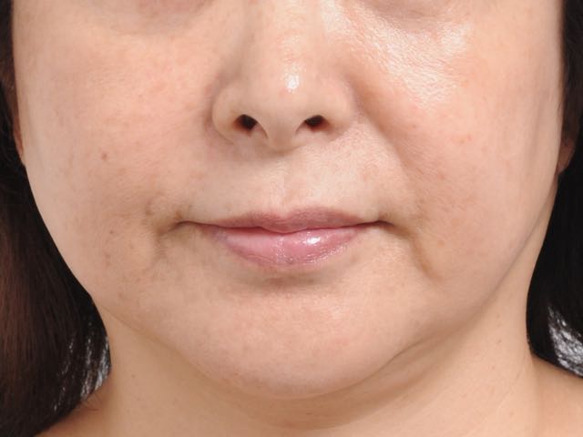 フェイスリフト後1 フェイスリフト後1