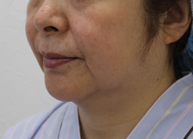 フェイスリフト前2 フェイスリフト前2