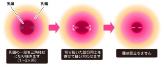 男の乳頭縮小について