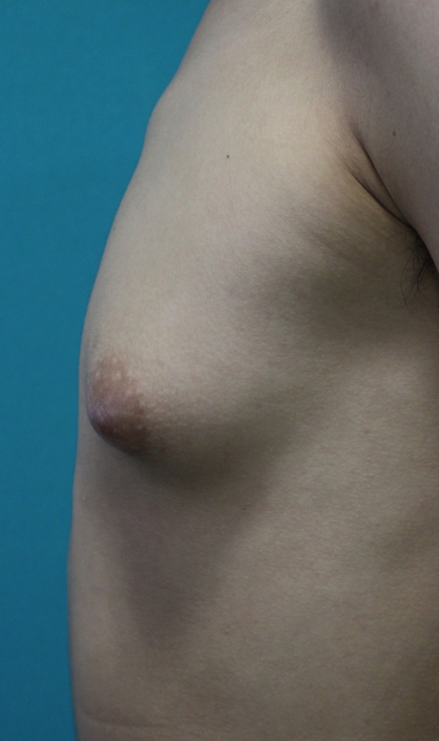女性化乳房手術前真横 女性化乳房手術前真横
