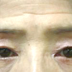 自然な若返りをしたいかたのための上まぶたタルミ解消手術