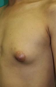 実は片側が多い男の真性女性化乳房
